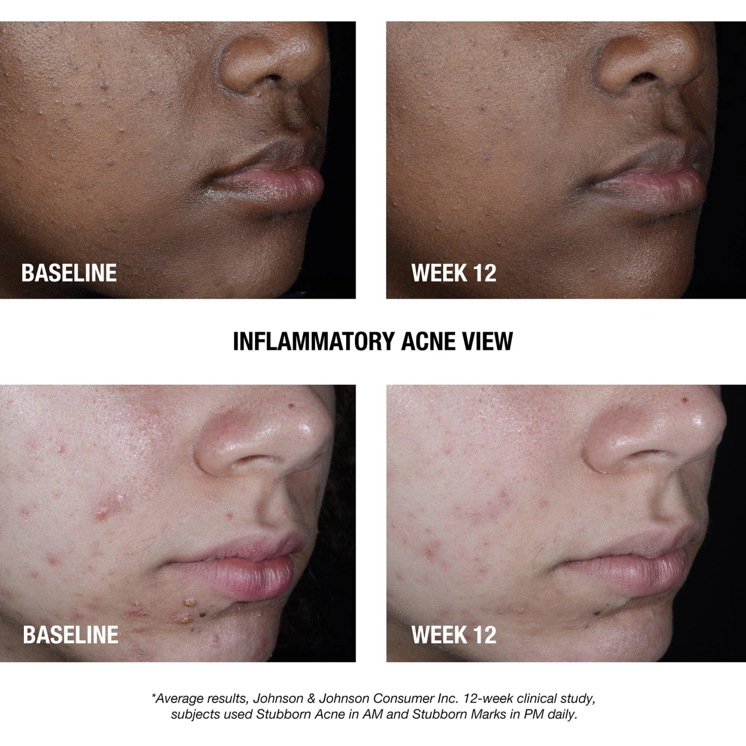 Neutrogena STUBBORN MARKS PM TREATMENT 4 Neutrogena STUBBORN MARKS PM TREATMENT - Image 4