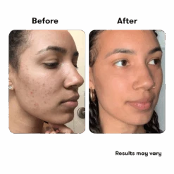 PROACTIVMD 3-STEP ACNE TREATMENT SYSTEM STARTER SET -Cosmetics Store 2580427cm alt04