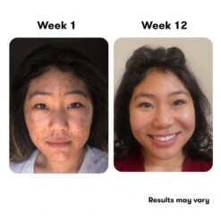 PROACTIV+ 3-STEP ACNE TREATMENT SYSTEM STARTER SET -Cosmetics Store 2585151cm alt04