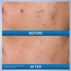 Cerave SALICYLIC ACID ACNE CONTROL GEL, ACNE TREATMENT FOR FACE -Cosmetics Store 2586059cm alt04